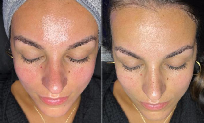 Image 3: Refresh Your Look with Hydra Facial