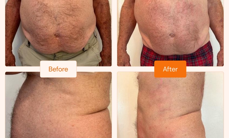Image 8: Up to 78% Off on Cryotherapy - Cryosurgery at Skin Memoirs by Arianna Nesbeth