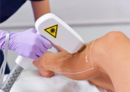 One Year of Unlimited Hair-Removal Treatments on Three Small Areas - Astoria Laser Spa