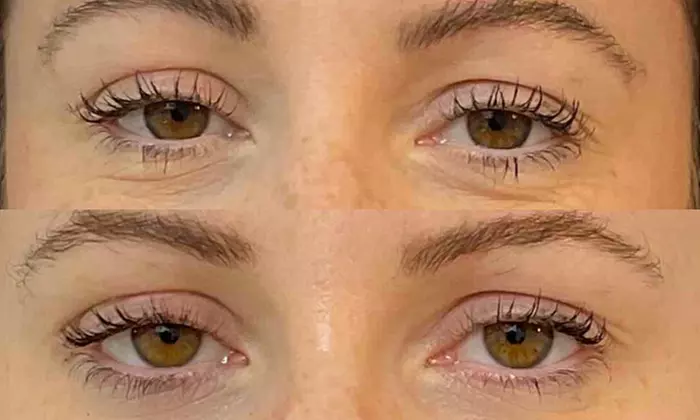 Rejuran Skin Booster Treatments, Offering (Up to 33% Off)