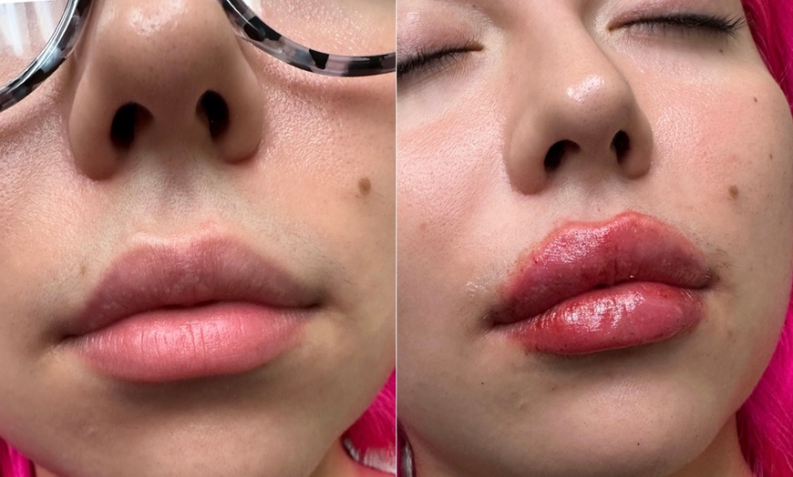 Image 2: Enhance Your Lips With One or Two Restylane Kysee Syringes