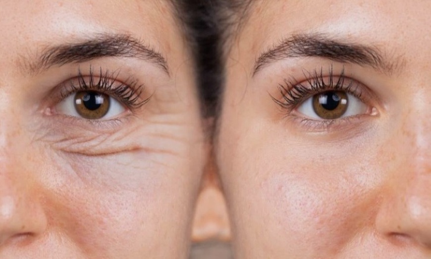 Image 2: Reveal Brighter, Younger-Looking Eyes with Eyelid Surgery