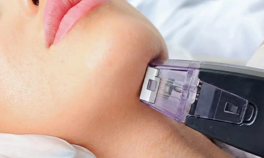 Experience Advanced RF Microneedling: Tighten & Rejuvenate Face, Neck, and Décolletage (Up to 40% Off) - Primary Image