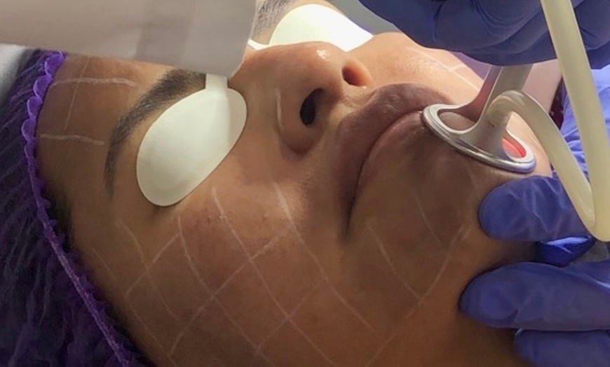 Image 2: Up to 57% Off on Laser Skin Resurfacing at Fiori di Lino MedSpa