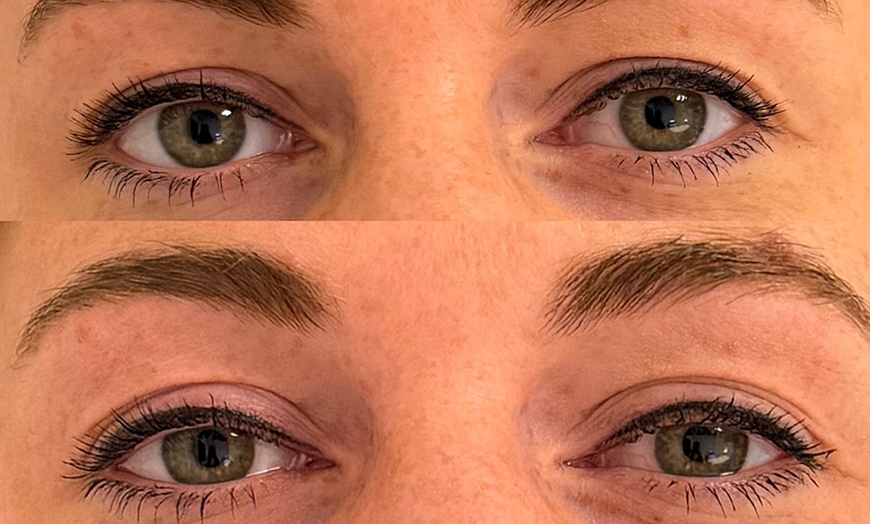 Image 2: Ontdek HIFU behandelingen voor hals, kaaklijn, onderkin of buik