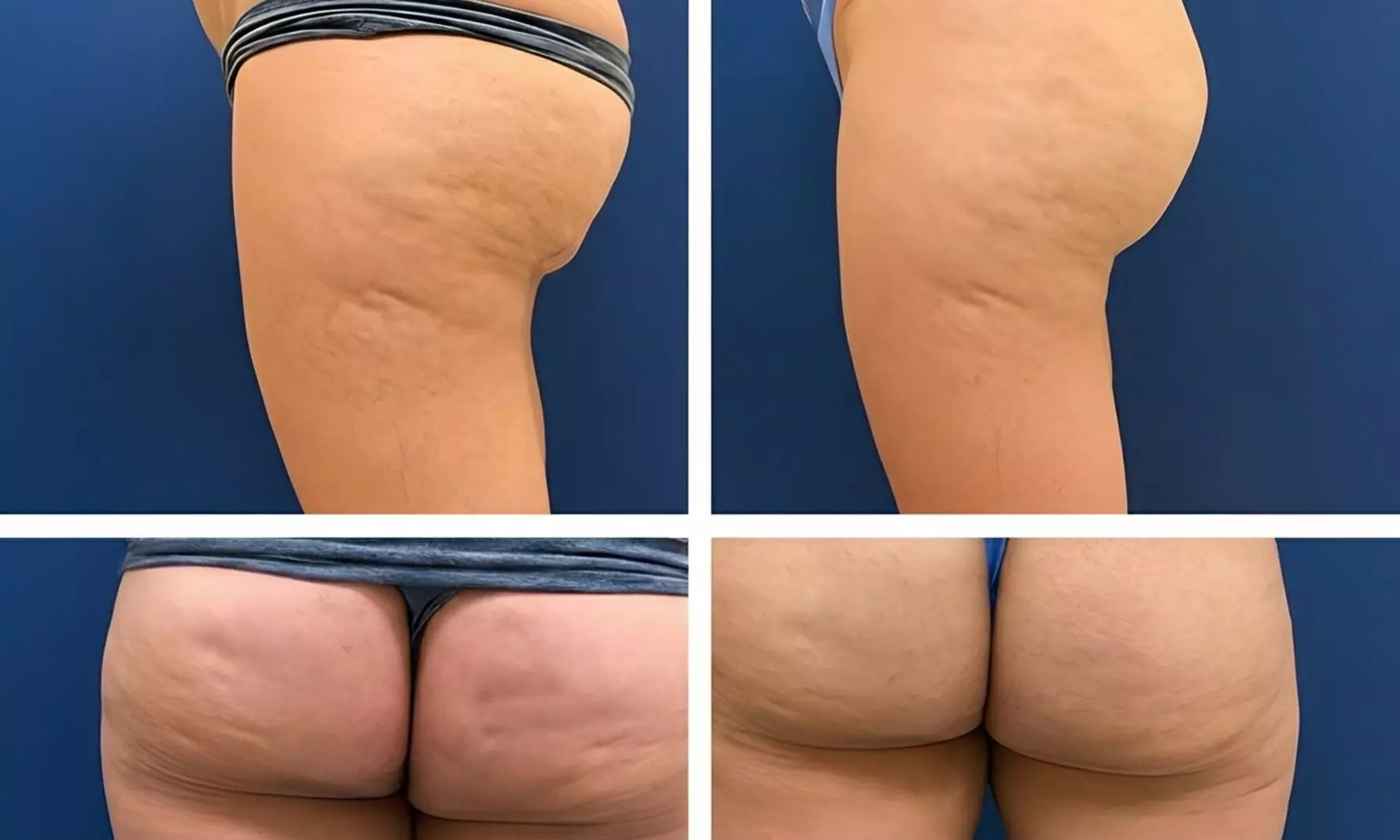 VelaShape Sessions for Targeted Body Contouring & Cellulite Reduction