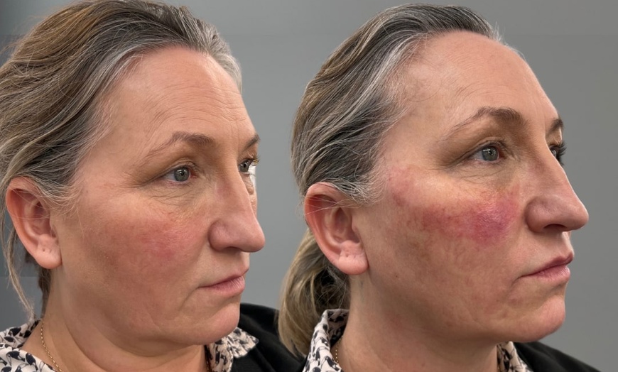 Image 10: Revitalize with 1ml, 2ml, or 3ml Dermal Fillers for Cheek, Jaw or Chin