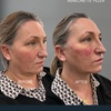 Image 10: Revitalize with 1ml, 2ml, or 3ml Dermal Fillers for Cheek, Jaw or Chin