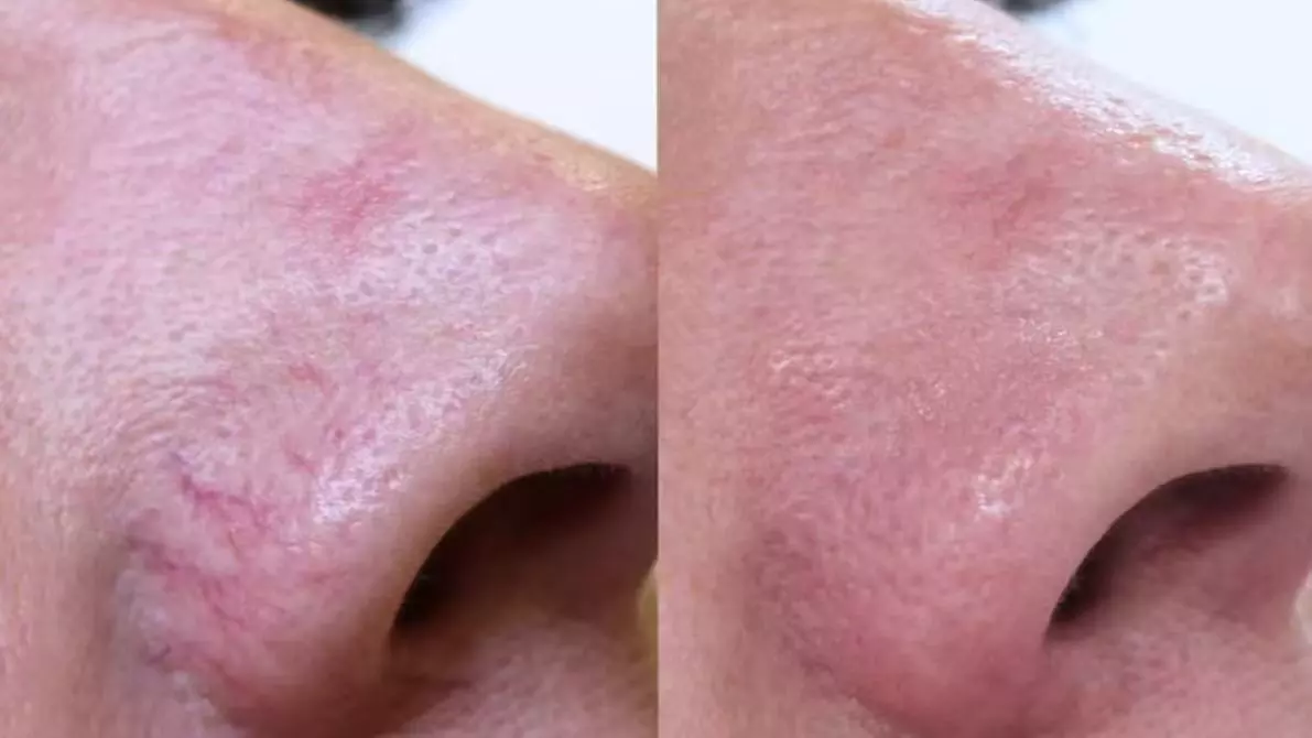 One or Two Spider Vein-Removal Sessions for One 2 x 2 Area