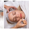 Image 1: Microneedling for Face & Neck or BB Glow Facial with Microneedling
