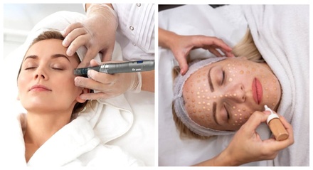 1 Session: Microneedling or Chemical Peel - For Face - Benson Beauty Aesthetics