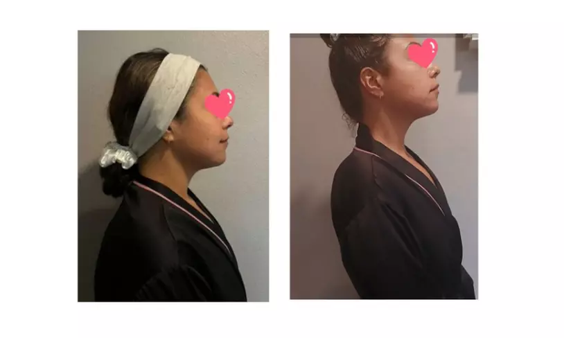 Radio Frequency Skin Tightening Sessions for Face and Double Chin