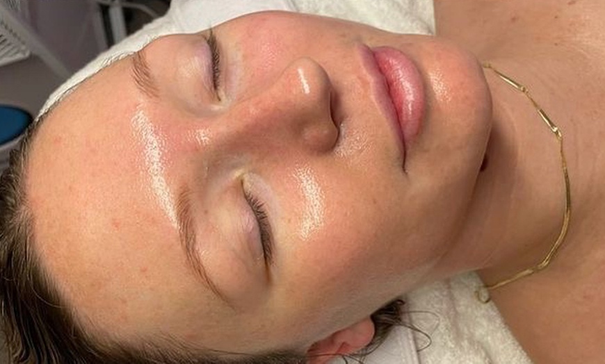 Image 3: Enhance Radiance with 1 or 2 Salmon DNA Microneedling