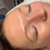 Image 3: Enhance Radiance with 1 or 2 Salmon DNA Microneedling