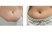 Get EM Sculpt Abs/Buttocks/Thighs in Just 30 Minutes at Harmony In Health (Up to 74% Off) - Second Medium