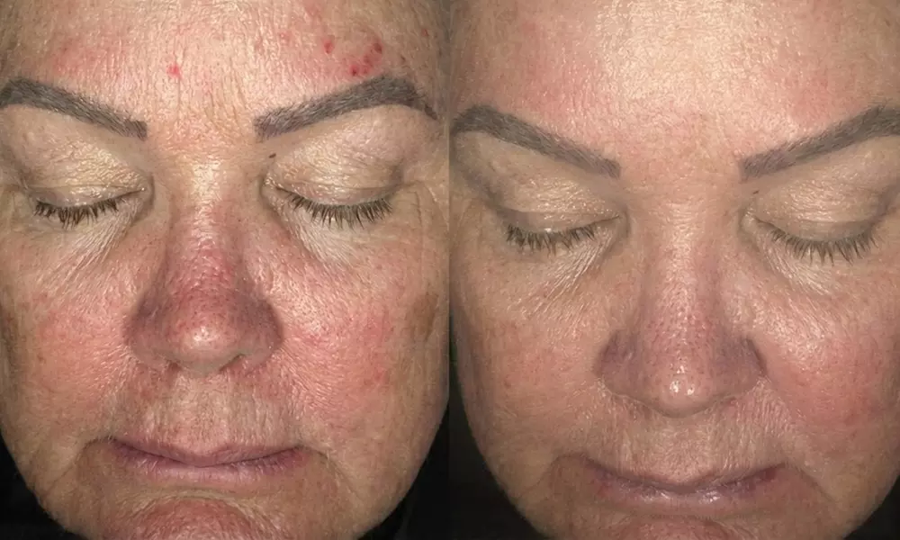 Glow Up with Pigmentation Removal or Skin Rejuvenation Sessions