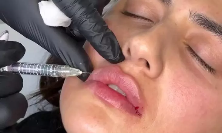 Enhance Your Lips with Russian Lip Enhancement Treatment