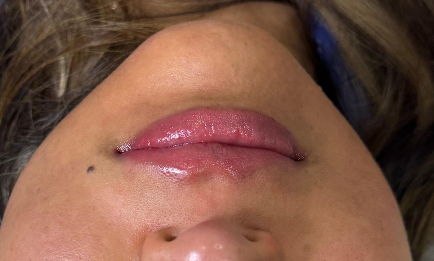 Image 8: Hidratación de labios efecto volumen con hyaluron pen