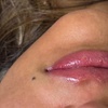 Image 8: Hidratación de labios efecto volumen con hyaluron pen