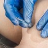 Image 1: Acupuncture Consultation and Treatment