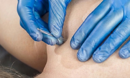 Acupuncture Consultation & Treatment - Family Care Acupuncture and Herbs