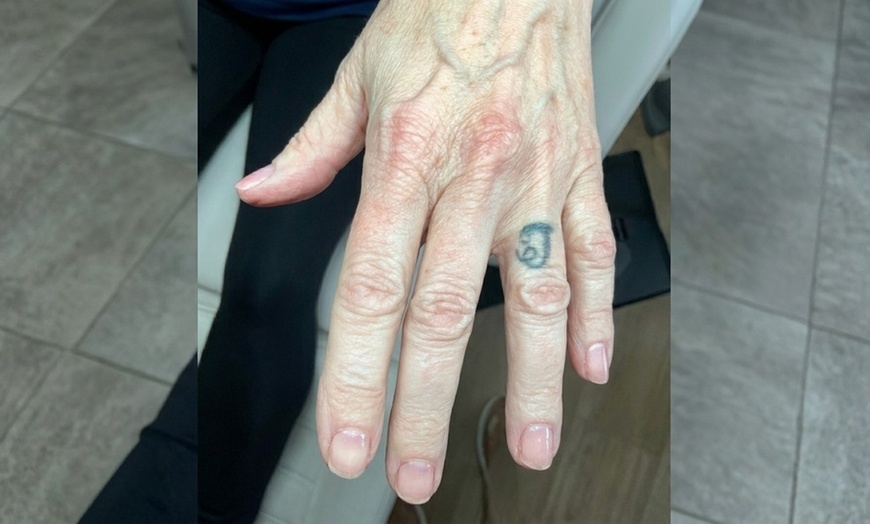 Image 2: 3 Laser Tattoo Removal Sessions: Small, Medium, Large or XL Areas