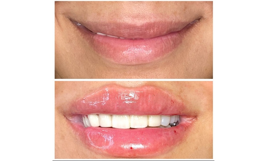 Image 7: Smooth, Plump & Perfect: Versa Enhancements at Divaa Beauty