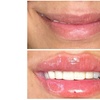Image 7: Smooth, Plump & Perfect: Versa Enhancements at Divaa Beauty