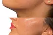 Get a Dermal Filler Today: 1ml or 2ml Lips at Benson Beauty Aesthetics (Up to 67% Off) - Image 4