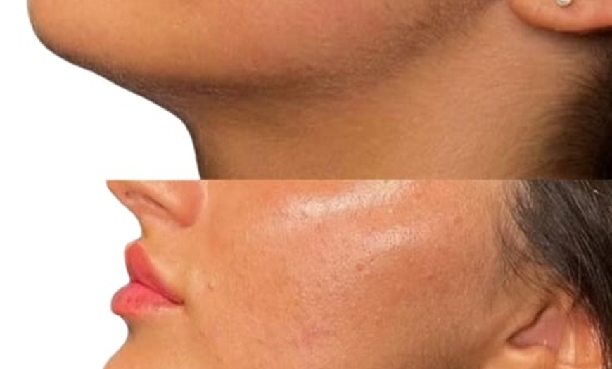 Image 4: Get a Dermal Filler Today: 1ml or 2ml Lips