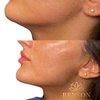 Image 4: Get a Dermal Filler Today: 1ml or 2ml Lips