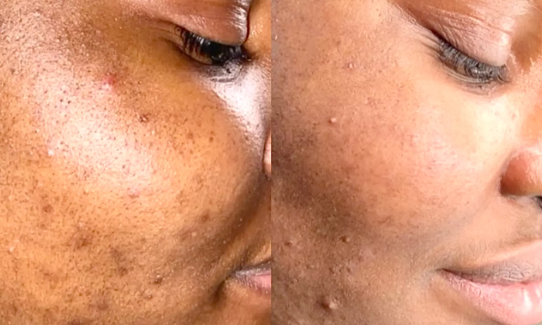 Chemical Peels & Facials: VI, BioRePeel, SENSI, Acne and Glass Skin