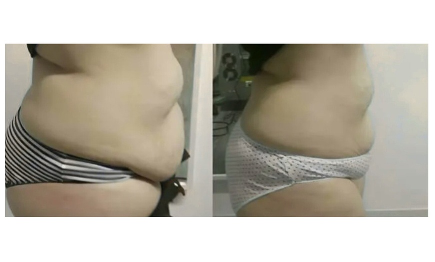 Image 3: One, Three, or Five Laser Lipo Sessions for Waistline