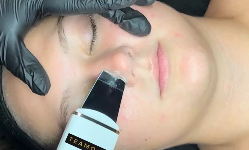 Image 8: CO2 Skin Rejuvenation for Face, Neck, & Eyes
