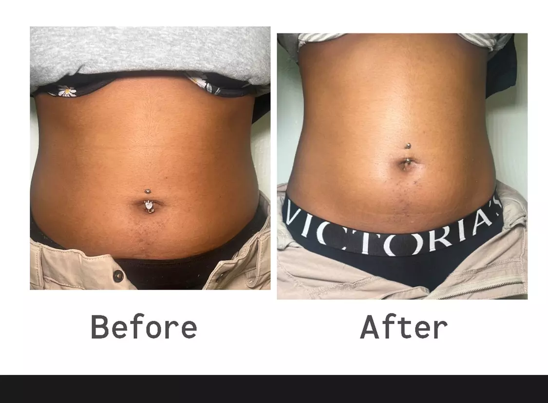 Up to 94% off on Laser Lipo and Ultrasonic Cavitation Treatments