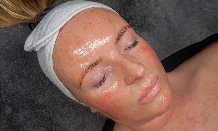 Image 2: One or Three Sessions of Microneedling with Skin Nourishing Serum