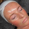 Image 2: One or Three Sessions of Microneedling with Skin Nourishing Serum