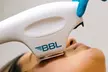 Get Glowing with BBL IPL Photofacial Treatments for Face, Neck, & Décolleté at DermaGlow MedSpa(Up to 51% Off) - Second Medium