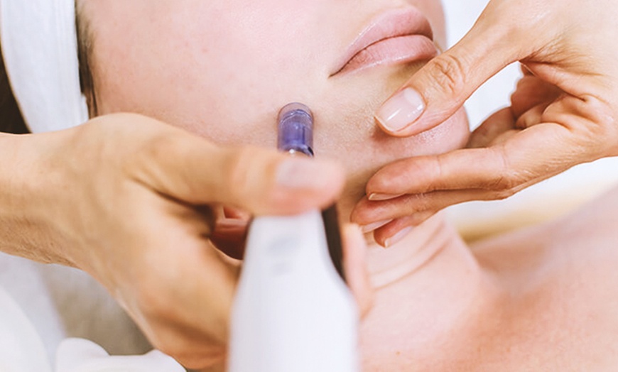Image 11: 1, 2 o 3 sesiones de microlifting facial de vitaminas con Dermapen