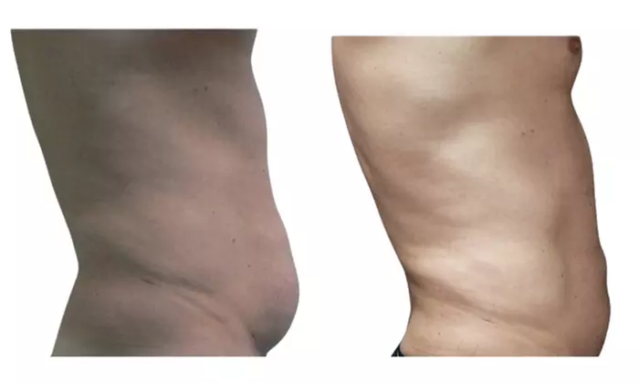 SmartLipo Triplex Laser Assisted Liposuction