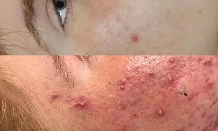 Permanent Acne Reduction with Blue Light Therapy: 1, 2 or 3 Treatments at Contours (Up to 50% Off) - Second Medium