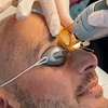 Image 3: Six Sessions of Laser Hair Removal with Candela GentleMax Pro