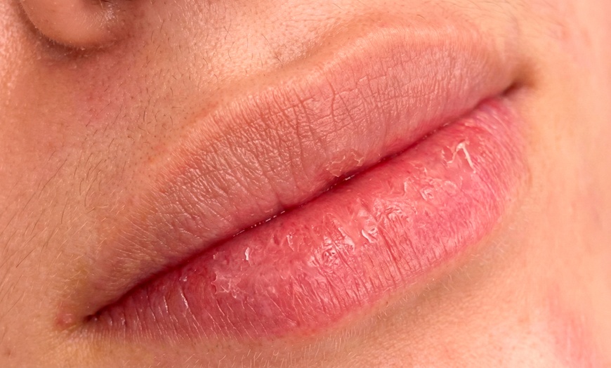 Image 6: Limpieza facial con tratamiento antiarrugas, hydralips, relleno y más