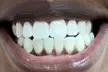 Revitalize Your Smile with One or Two Sessions of 90-Min Professional In Office Teeth Whitening (Up To 52% Off) - Second Medium