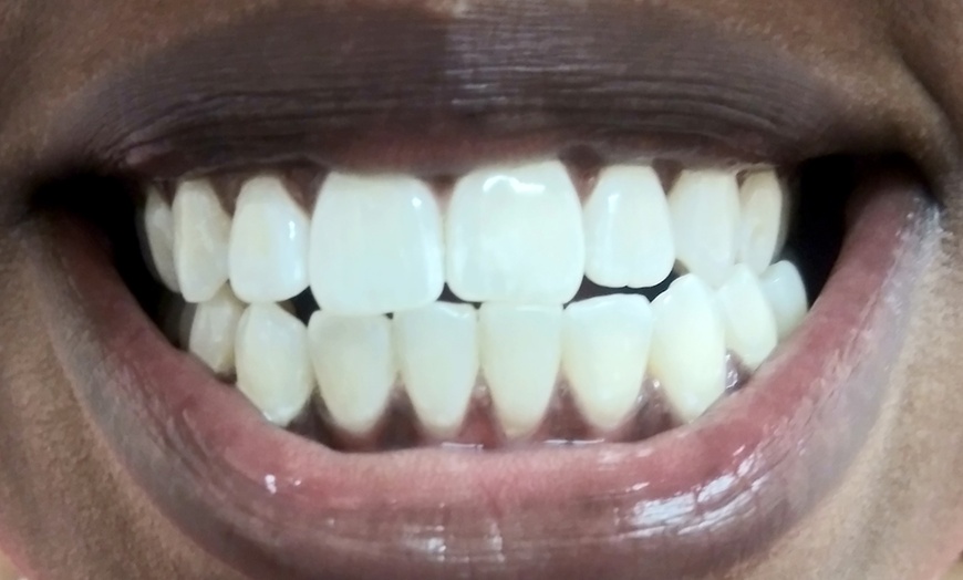 Image 2: Revitalize Your Smile: 1 or 2 Professional In Office Teeth Whitening