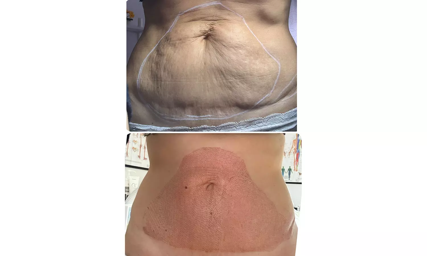 Plasma pen facial no quirúrgico para manchas y zona periocular