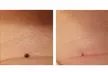 Discover Skin Care New York's effective skin tag, mole, and spot removal with laser tech, offering up to 50% off. - Second Medium