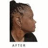 Image 5: Face-Slim – Non-Invasive Facial Fat Reduction at Your Sculpt Studio DC