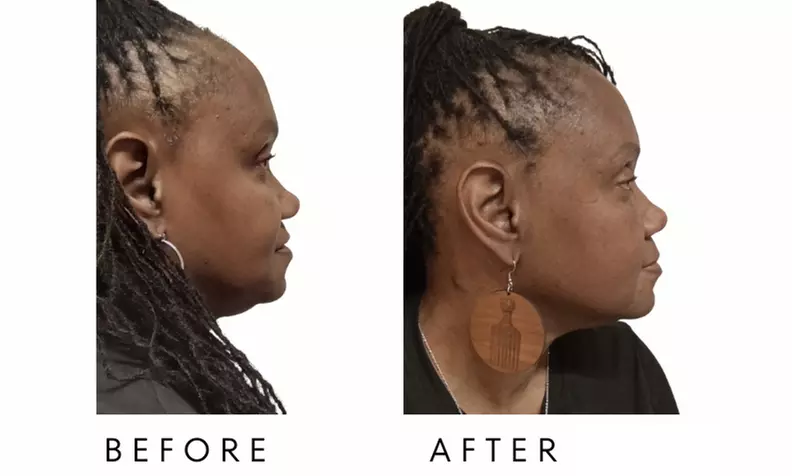 Face-Slim – Non-Invasive Facial Fat Reduction at Your Sculpt Studio DC