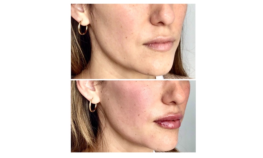 Image 2: Revitalize with 20 or 40 Units of Botox Or One Flip Lip